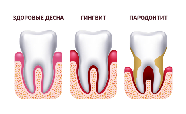 Пародонтит зубов: симптомы и стадии развития