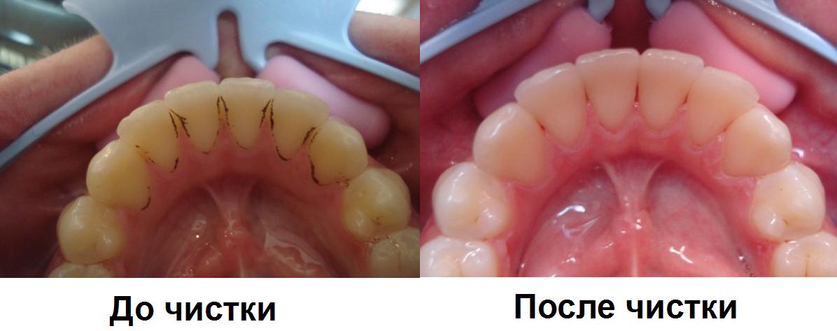 Снятие зубных отложений Томск Омская Лечение пародонтоза Томск Спичечный
