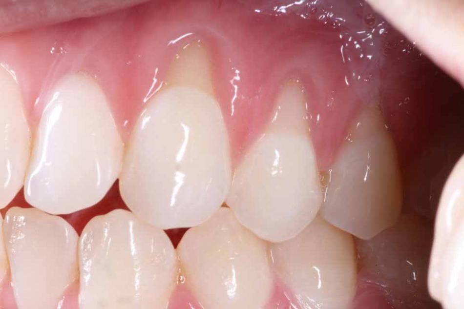 Как лечить оголение шейки зуба?