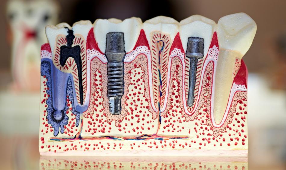 Какие методы имплантации зубов существуют?