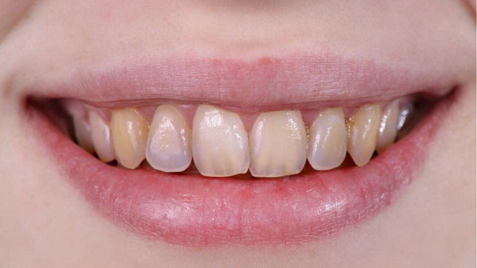 Деминерализация зубов - признаки и причины.
