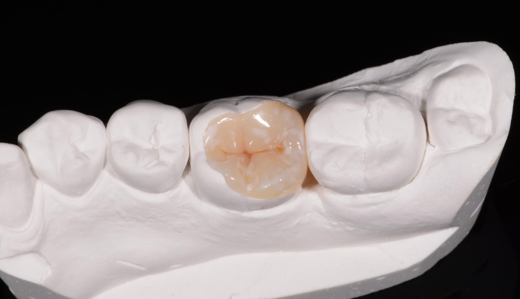 Можно ли восстановить отколовшийся коренной зуб?